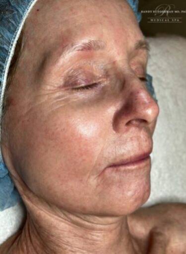 Facial or chemical peel patient photo, three-quarter view of the facial skin — Dr. Rudderman, Atlanta.