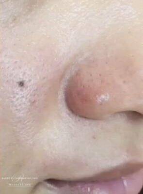 Facial or chemical peel patient photo, three-quarter view of the facial skin — Dr. Rudderman, Atlanta.
