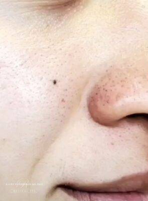 Facial or chemical peel patient photo, three-quarter view of the facial skin — Dr. Rudderman, Atlanta.