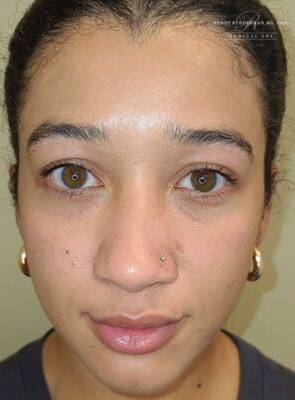 Facial or chemical peel patient photo, front view of the facial skin — Dr. Rudderman, Atlanta.