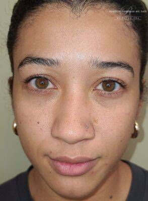 Facial or chemical peel patient photo, front view of the facial skin — Dr. Rudderman, Atlanta.