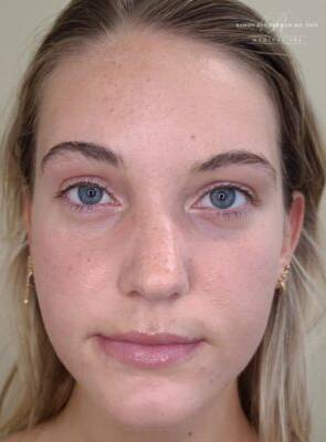 Facial or chemical peel patient photo, front view of the facial skin — Dr. Rudderman, Atlanta.