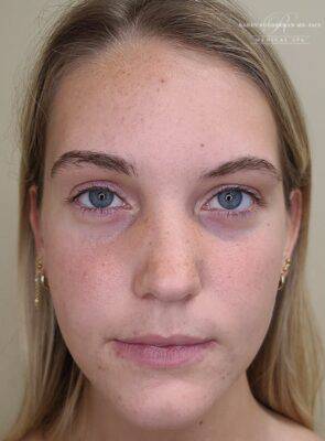 Facial or chemical peel patient photo, front view of the facial skin — Dr. Rudderman, Atlanta.