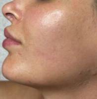 Facial or chemical peel patient photo, side profile view of the facial skin — Dr. Rudderman, Atlanta.