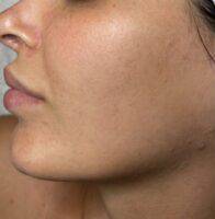 Facial or chemical peel patient photo, side profile view of the facial skin — Dr. Rudderman, Atlanta.