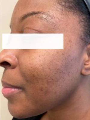Face after facial or chemical peel, three-quarter view — Dr. Rudderman, Atlanta.