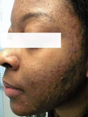Face before facial or chemical peel, three-quarter view — Dr. Rudderman, Atlanta.