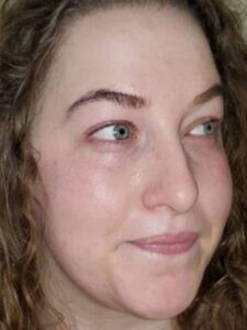 Facial or chemical peel patient photo, three-quarter view of the facial skin — Dr. Rudderman, Atlanta.