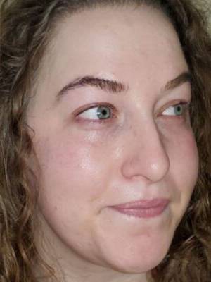 Facial or chemical peel patient photo, three-quarter view of the facial skin — Dr. Rudderman, Atlanta.