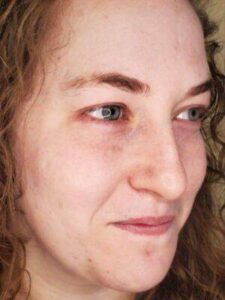 Facial or chemical peel patient photo, three-quarter view of the facial skin — Dr. Rudderman, Atlanta.