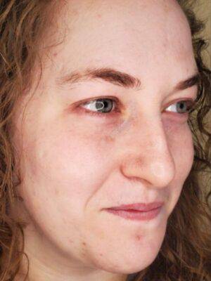 Facial or chemical peel patient photo, three-quarter view of the facial skin — Dr. Rudderman, Atlanta.