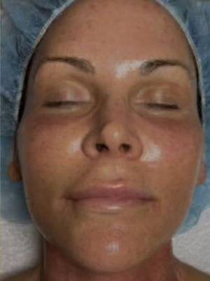 Facial or chemical peel patient photo, front view of the facial skin — Dr. Rudderman, Atlanta.