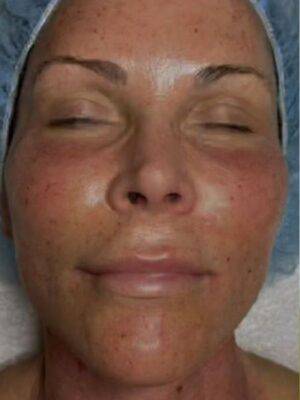 Facial or chemical peel patient photo, front view of the facial skin — Dr. Rudderman, Atlanta.