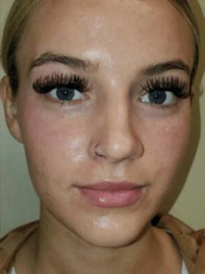 Facial or chemical peel patient photo, front view of the facial skin — Dr. Rudderman, Atlanta.