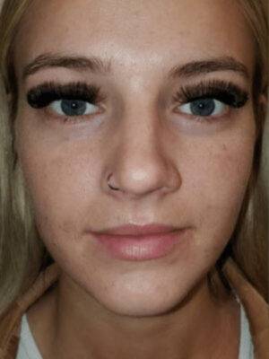 Facial or chemical peel patient photo, front view of the facial skin — Dr. Rudderman, Atlanta.