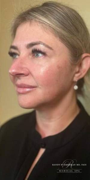 Dermal filler treatment patient photo, side profile view of the face — Dr. Rudderman, Atlanta.