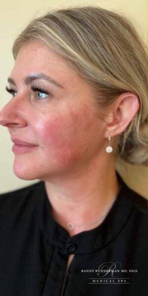 Dermal filler treatment patient photo, side profile view of the face — Dr. Rudderman, Atlanta.