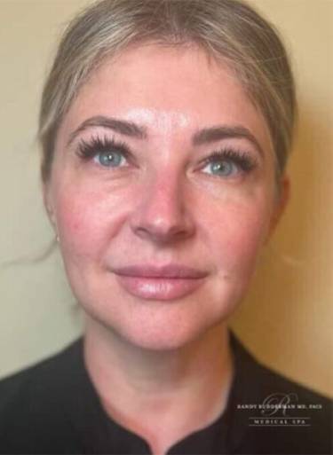 Dermal filler treatment patient photo, front view of the face — Dr. Rudderman, Atlanta.