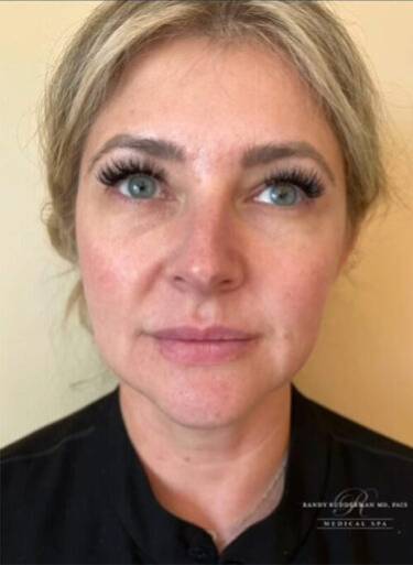 Dermal filler treatment patient photo, front view of the face — Dr. Rudderman, Atlanta.