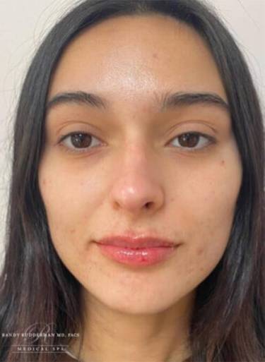 Dermal filler treatment patient photo, front view of the face — Dr. Rudderman, Atlanta.