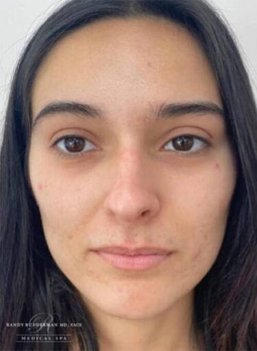 Dermal filler treatment patient photo, front view of the face — Dr. Rudderman, Atlanta.
