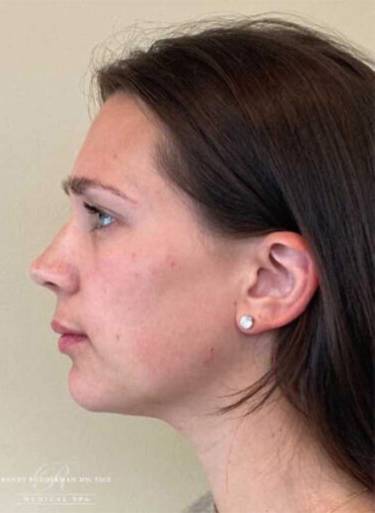 Dermal filler treatment patient photo, side profile view of the face — Dr. Rudderman, Atlanta.