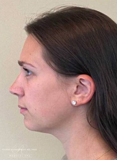 Dermal filler treatment patient photo, side profile view of the face — Dr. Rudderman, Atlanta.