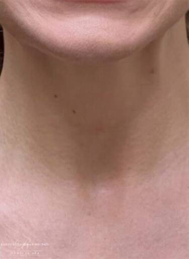 Dermal filler treatment patient photo, front view of the face — Dr. Rudderman, Atlanta.