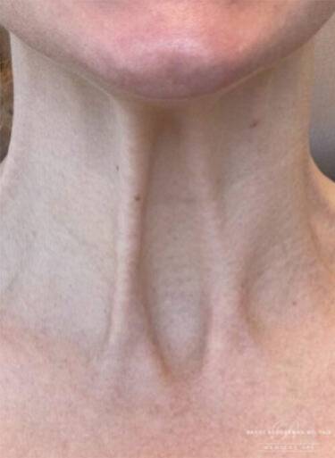 Dermal filler treatment patient photo, front view of the face — Dr. Rudderman, Atlanta.