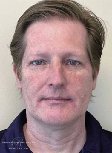 Dermal filler treatment patient photo, front view of the face — Dr. Rudderman, Atlanta.