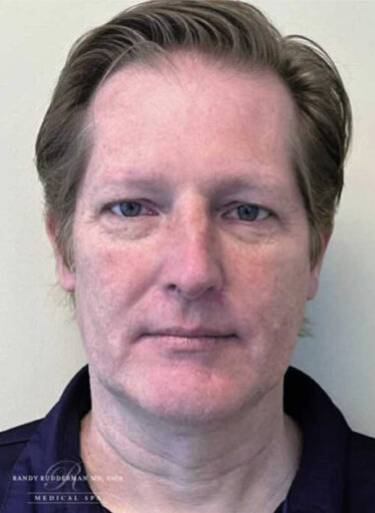 Dermal filler treatment patient photo, front view of the face — Dr. Rudderman, Atlanta.