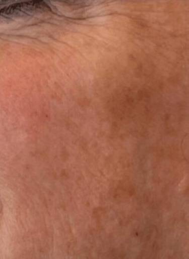 Dermal filler treatment patient photo, three-quarter view of the face — Dr. Rudderman, Atlanta.