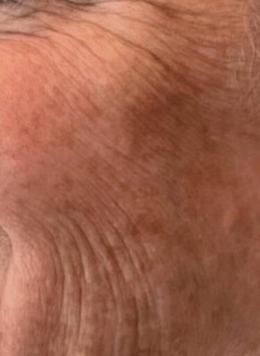 Dermal filler treatment patient photo, three-quarter view of the face — Dr. Rudderman, Atlanta.