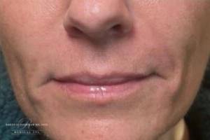 Dermal filler treatment patient photo, front view of the face — Dr. Rudderman, Atlanta.