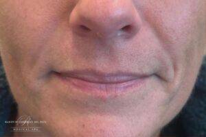 Dermal filler treatment patient photo, front view of the face — Dr. Rudderman, Atlanta.