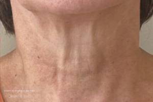 Dermal filler treatment patient photo, front view of the face — Dr. Rudderman, Atlanta.