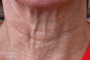 Dermal filler treatment patient photo, front view of the face — Dr. Rudderman, Atlanta.