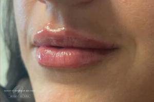 Face after dermal filler treatment, front view — Dr. Rudderman, Atlanta.