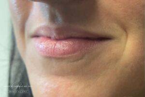 Face before dermal filler treatment, front view — Dr. Rudderman, Atlanta.
