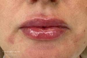 Face after dermal filler treatment, front view — Dr. Rudderman, Atlanta.