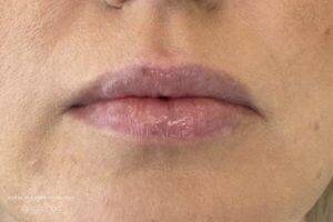 Face before dermal filler treatment, front view — Dr. Rudderman, Atlanta.