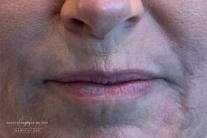 Dermal filler treatment patient photo, front view of the face — Dr. Rudderman, Atlanta.