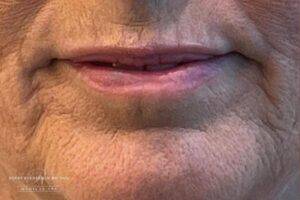 Dermal filler treatment patient photo, front view of the face — Dr. Rudderman, Atlanta.