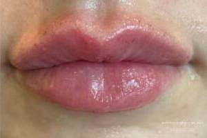 Face after dermal filler treatment, front view — Dr. Rudderman, Atlanta.