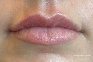 Face before dermal filler treatment, front view — Dr. Rudderman, Atlanta.