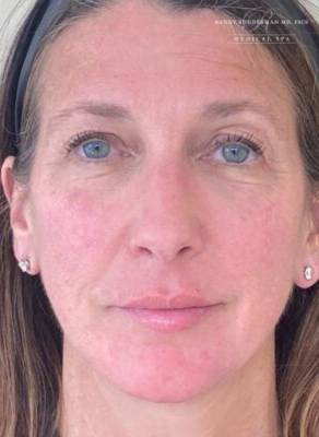 Dermal filler treatment patient photo, front view of the face — Dr. Rudderman, Atlanta.