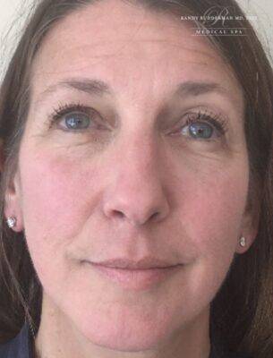 Dermal filler treatment patient photo, front view of the face — Dr. Rudderman, Atlanta.
