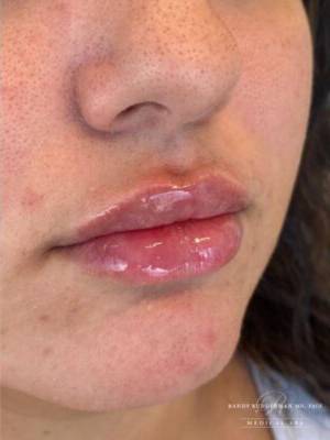 Face after dermal filler treatment, three-quarter view — Dr. Rudderman, Atlanta.
