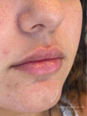 Face before dermal filler treatment, three-quarter view — Dr. Rudderman, Atlanta.
