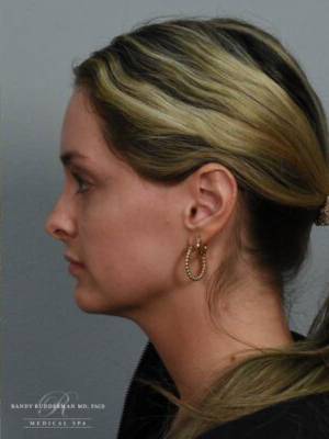 Dermal filler treatment patient photo, side profile view of the face — Dr. Rudderman, Atlanta.